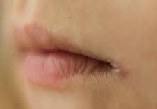 甚麼是口角炎 (Angular Stomatitis) ? - Presentation by Dr. Yeung Ho Hong(楊浩康)