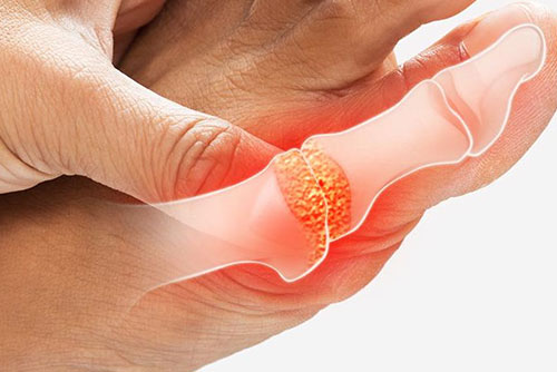 甚麼是痛風 Gout？ - Presentation by Dr. Yeung Ho Hong(楊浩康)
