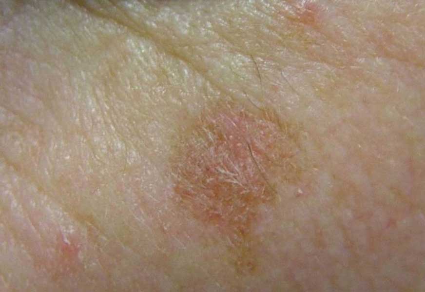 甚麼是日光性角化 (Solar Keratosis)？ - Presentation by Dr. Yeung Ho Hong(楊浩康)